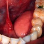 Jaw Cysts & Tumors